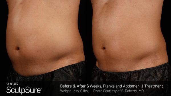 6 weeks after our revolutionary new body contouring system: Sculpsure.