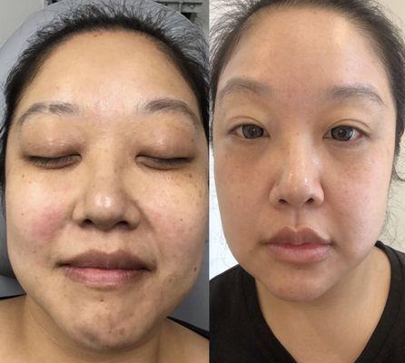 The laser treatment got rid of my rosacea, hyperpigmentations, and bumpy texture. Hilary's recommendation definitely worked wonderfully!