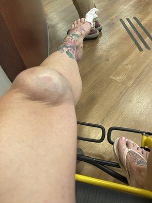 Knee before it started looking REALLY bad. This is where I was left with no way to hold my leg up.