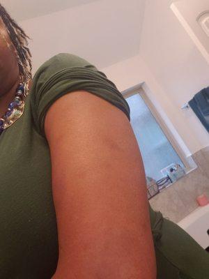 Bruises from massage less than 24 hours afterwards