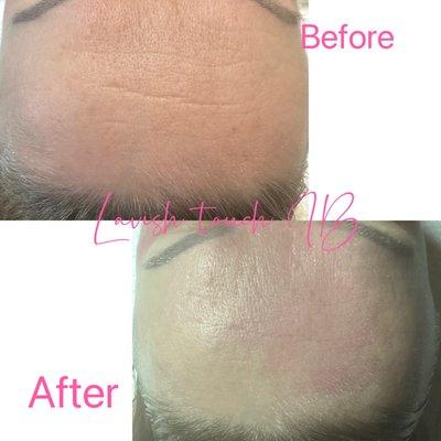Deep pore cleaning and skin rejuvination