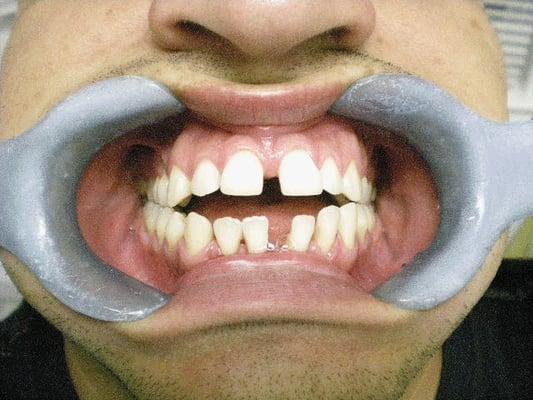 This very nice young man chose not to socialize for many years because his teeth were scaring a lot of people...