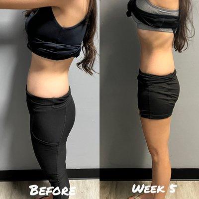 NorCal Cryoslim - EmShapeWell (My before and after. Side view)