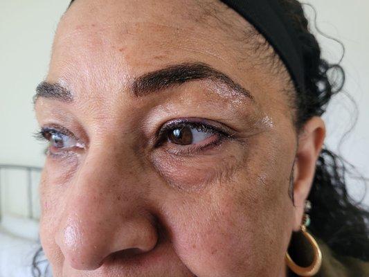 Right after procedure