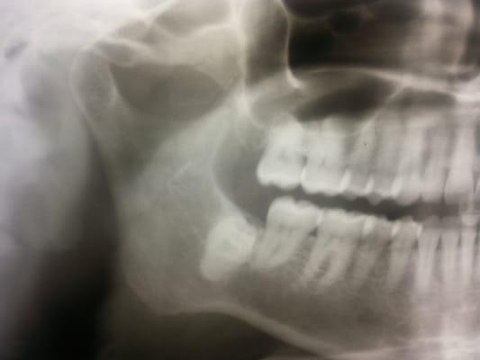 Wisdom tooth impacted
