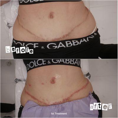 Before + After 1st lightening treatment on Liposuction scar
