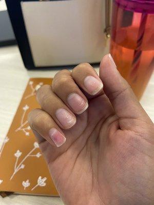 Pinky is completely exposed and there is no nail bed there