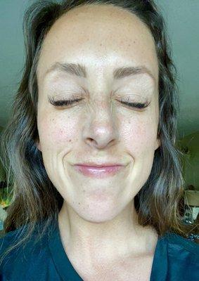5 days post tox with Premier Rejuvenation, so happy with my results. Making the same face in previous photo. How's that for no wrinkles??