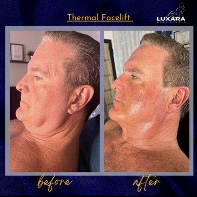 TALK ABOUT TRANSFORMATION
You can see the complete transformation in his face! And this is only after 6 sessions