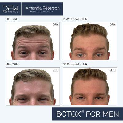 Botox for Men by Amanda Peterson