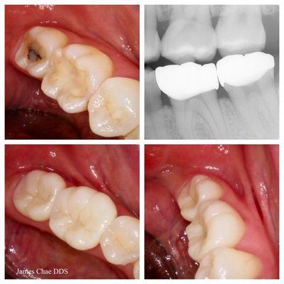Monolithic zirconia crowns. Severe clenching and grinding.