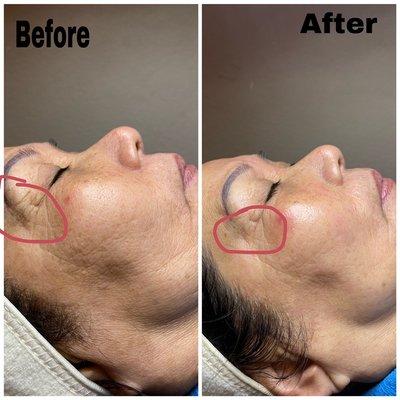 Wrinkle facial treatment