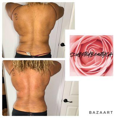 One treatment of a two hour body sculpting session on her back