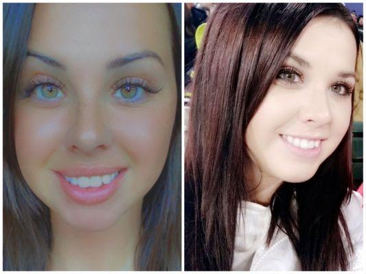 Left is after with lip flip & right was before!