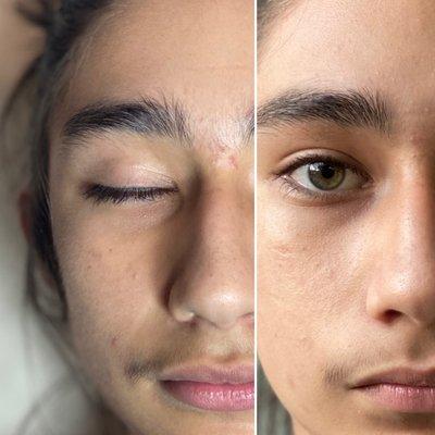 Teen facials custom to your teen needs