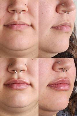 Filler: Lips