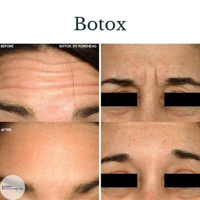 Botox at Haber Dermatology