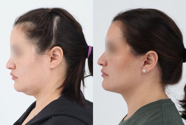 42 yo 4 months after Face, Neck lift, erbium laser around eyes by Dr. Chouake.