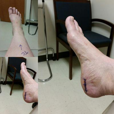 This was just a few days post surgery. It has since healed nicely and I am back on my feet.