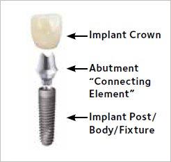 Single tooth implant