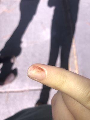 My ripped off nail