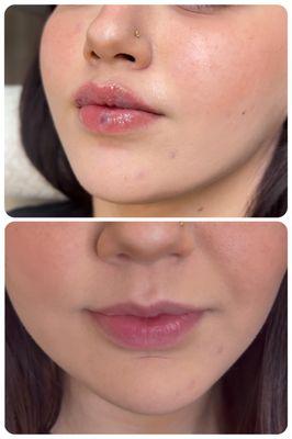 Lip Augmentation with Russian Lip Injection Technique Using Restylane Kysse