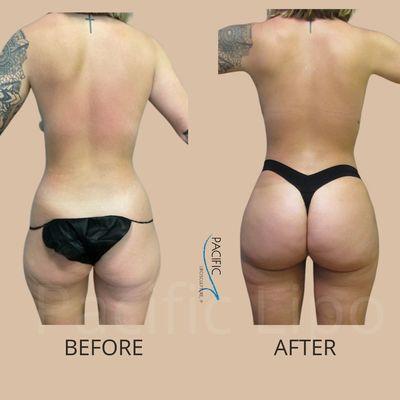 Pacific Lipo - Los Angeles