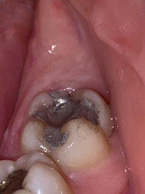 A closer look of the filling aftermath of getting it fixed.