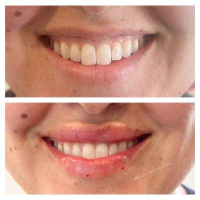 Gummy smile treatment and RHA lip filler