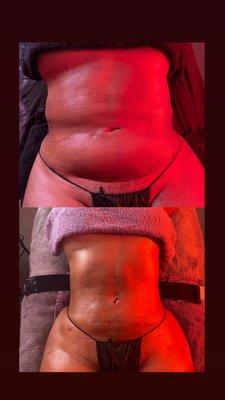 Lymphatic drainage 10 session bundle package