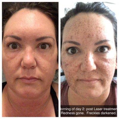 Amazing! Freckles vanished. This is after 1 treatment. 3 are recommended.