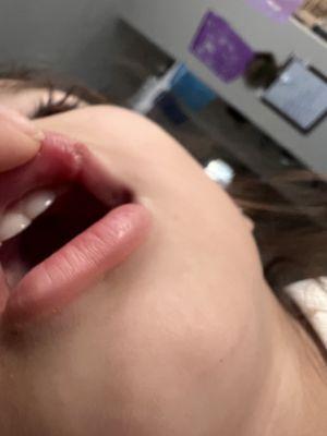 Busted lip