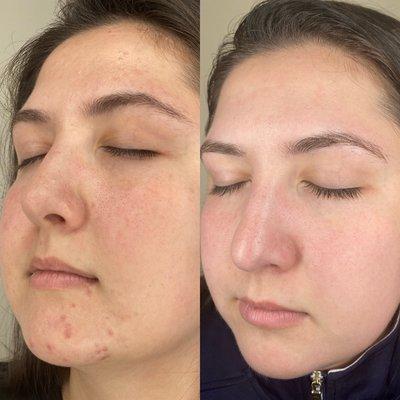 Acne Treatment results