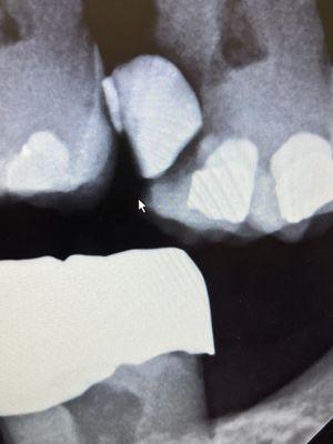 This is an x-ray of a tooth. Then he said it had been shipped and needed to be removed a molar.