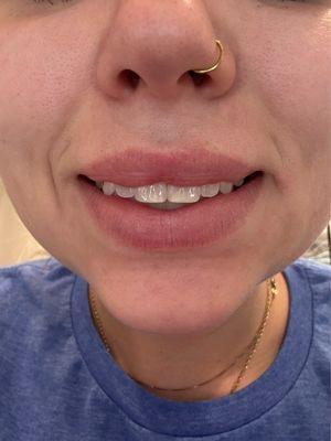 Lumpy lip line that makes me hate smiling