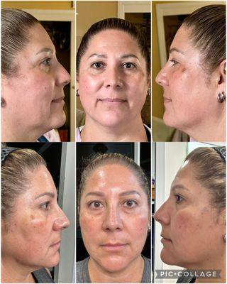After 2 treatments if kybella on my double chin and 1 treatment of threads on my face