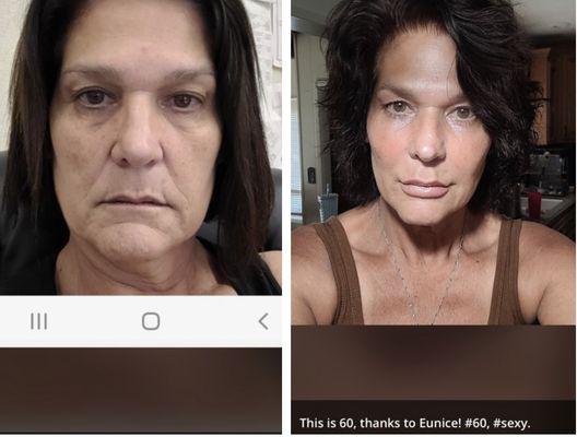 Left photo is before she met Eunice and right photo is during treatments with Eunice (combination of
Skin care, Botox, and fillers)