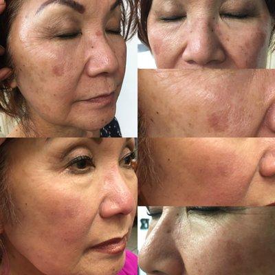 Nu derm system transformation.