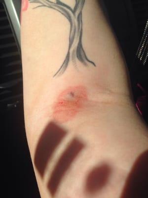 My right arm after visiting LabCorp