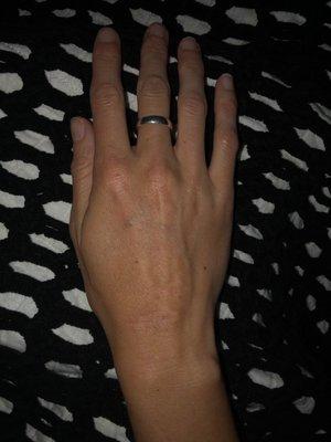 Today. I have this scar because I didn't listen to leave it out of the sun for a year. It's hard when you live in CA