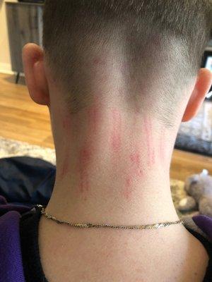 Abrasions from the clippers