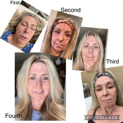 Virtue RF , subnovii , tetra cool peel AnteageMD