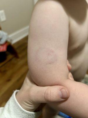 Unreported bite mark