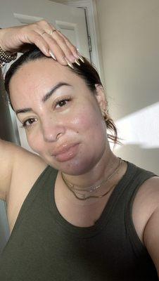 SkinVive done in February 2024 (photo taken in June 2024)