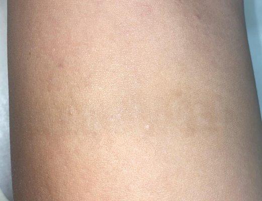 Advanced Aesthetics Ink Laser Tattoo Removal