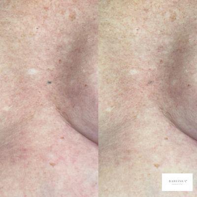 Radiation Tattoo Camouflage