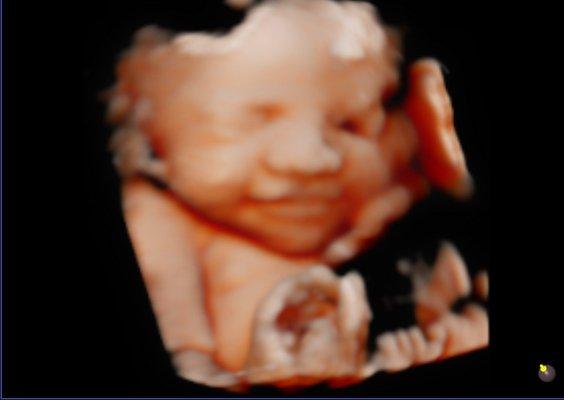 Baby smiling in 3D/4D ultrasound