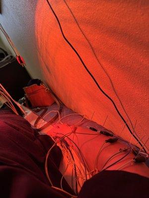 Red light therapy and acupuncture on my right arm