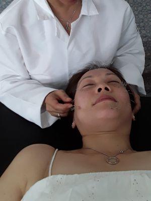 AcuFacial rejuvenation                                    针灸面部年轻化