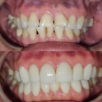 Before and after cosmetic dentistry